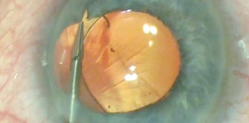 Iris Coloboma