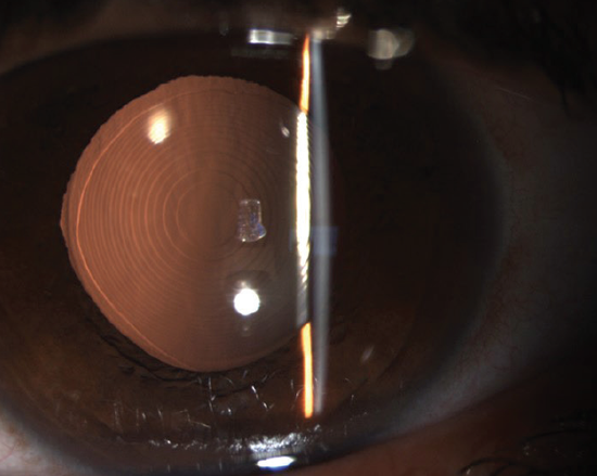 Strategies for Correcting Presbyopia