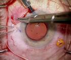 Repositioning a Dislocated Multifocal IOL With the Yamane Technique thumbnail
