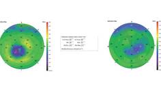 Epithelial Thickness Mapping for the Detection and Management of Corneal Irregularities