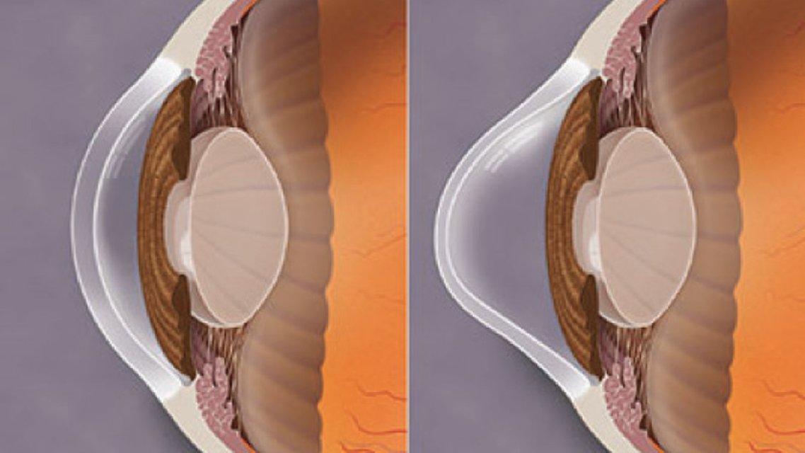Keratoconus and IOL Calculations