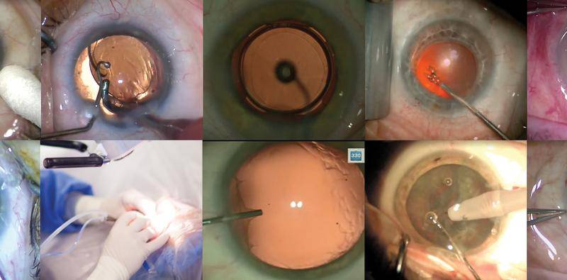 My Basic Cataract Technique
