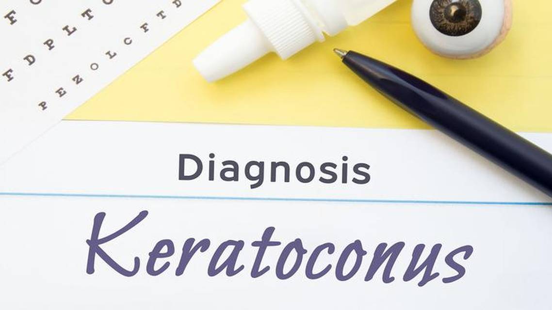 I Underwent CXL to Treat My Keratoconus