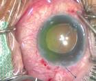 Flanged Technique for Capsular Tension Segment Fixation