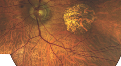 More Than 20 Radial Keratotomy Incisions