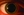 Figure 1. Black IOFB, likely gunpowder residue, is embedded in the conjunctiva of the right eye. Greenish-brown discoloration is observed in the right iris.
