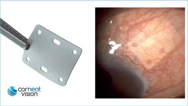FDA Clears CorNeat EverPatch, World's First Non-Degradable, Synthetic Tissue Substitute for Ophthalmic Surgery image