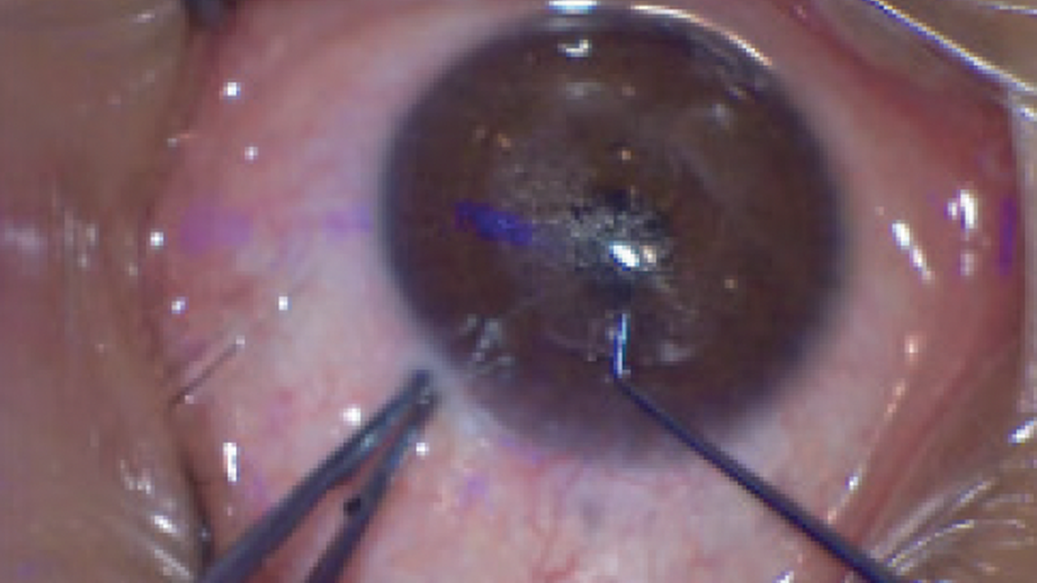 How to Master Small Incision Lenticule Extraction