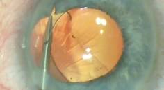 Iris Coloboma