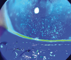 Freeze Dried Amniotic Membrane for Filamentary Keratitis