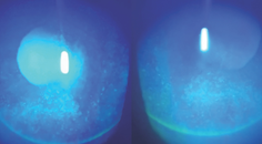 Testing Corneal Sensation Is Important