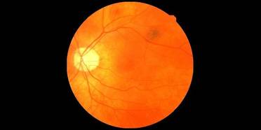AI Can Identify Heart Disease From an Eye Scan image