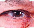 Secondary IOL Implantation After Complicated Primary Surgery