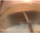 Hand in Hand MIGS and Advanced Refractive Cataract Surgery