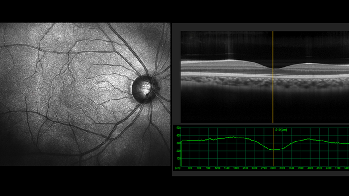 Macular OCT Imaging Before Cataract Surgery