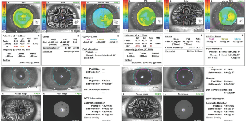 Decreased Vision From Thygeson Superficial Punctate Keratitis
