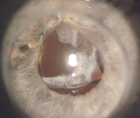 IOL Dislocation After Penetrating Keratoplasty