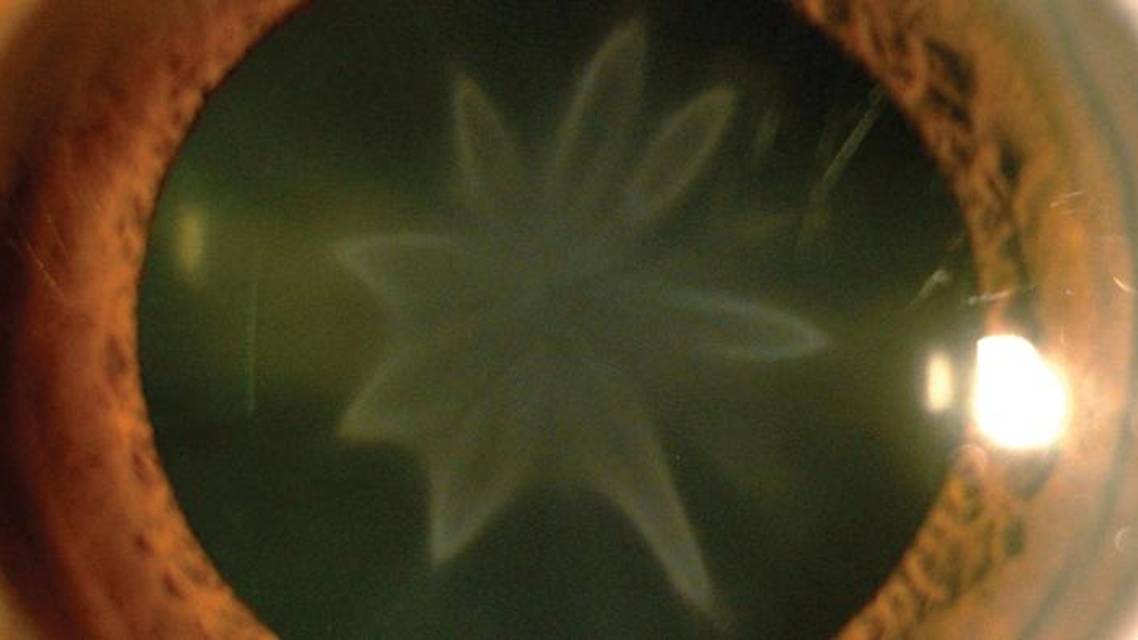 Star Shaped Cataract