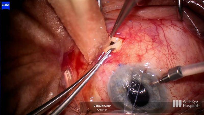 Bleb Revision and Management of Choroidal Effusions thumbnail