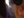 Figure 16. Before surgery, there is a tear in the inferior edge of the LASIK flap with significant epithelial ingrowth.