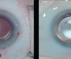 The New ZEISS CT LUCIA 621P IOL
