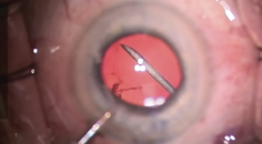 Clinically Significant Vitreous Opacities