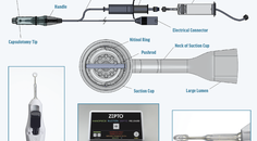 Continuing Excellence in Capsulotomy Innovation with Zepto