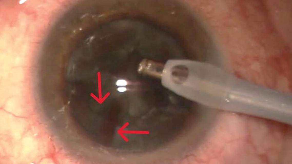Alternative IOL Fixation After Posterior Capsular Rupture