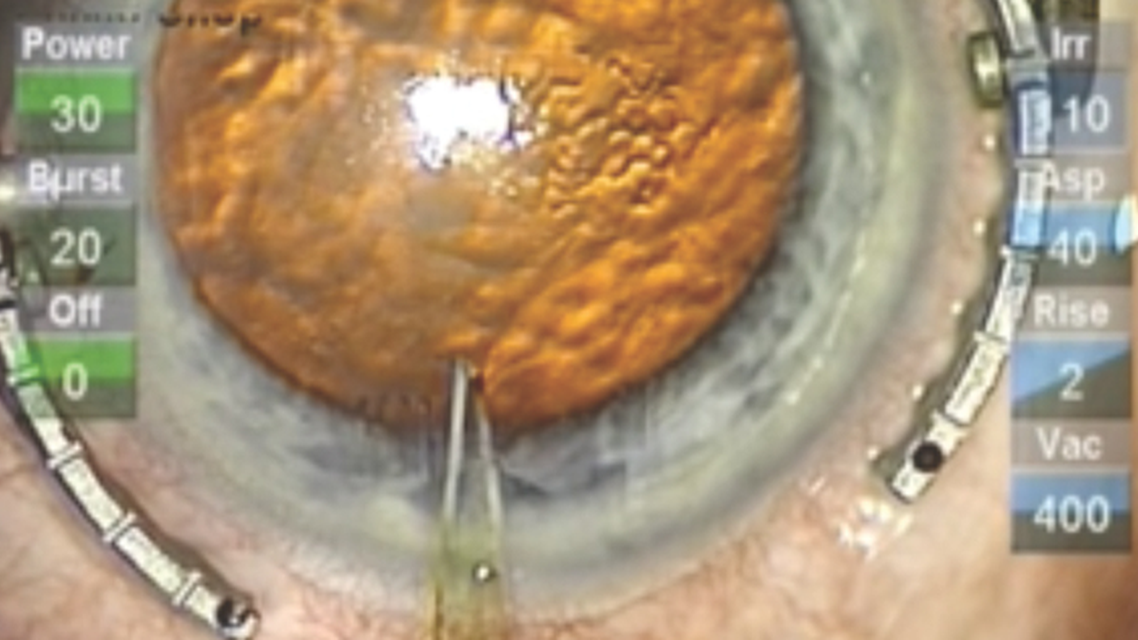 Optimizing the Incision