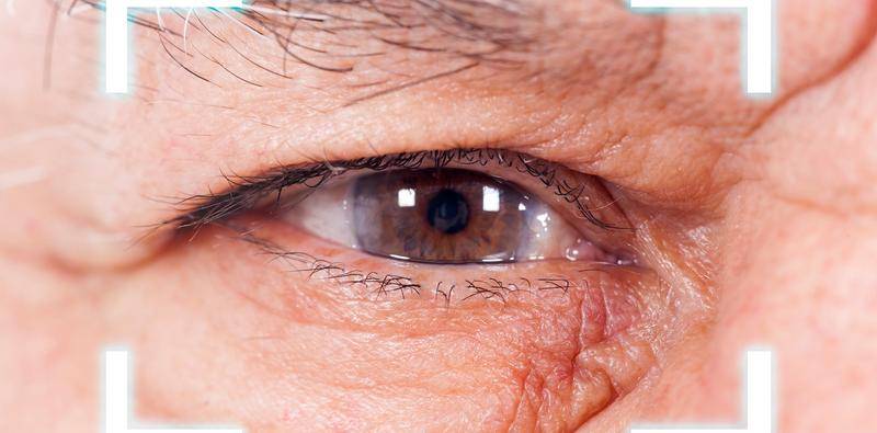 Cataract Surgery After SMILE