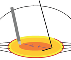 Zonulopathy and the Dense Cataract