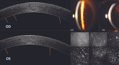 Punctiform and Polychromatic Pre Descemet Corneal Dystrophy