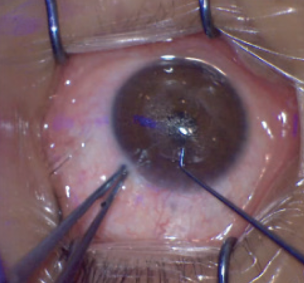 How to Master Small Incision Lenticule Extraction