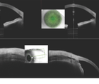 The Role of Anterior Segment OCT in MIGS