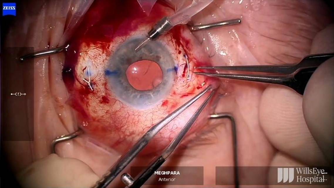 GoreTex Sutured Envista Envy thumbnail