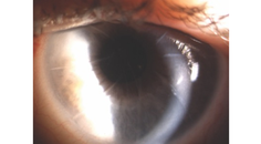 Refractive Treatment Options After Radial Keratotomy