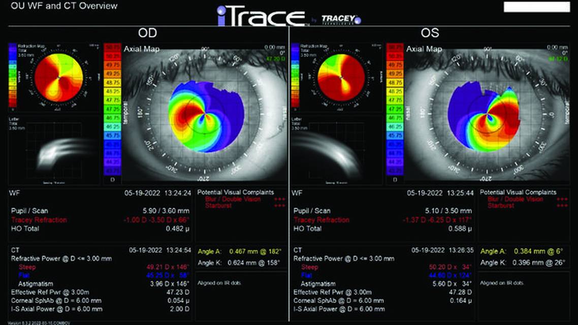 Contact Lens Intolerance After CXL