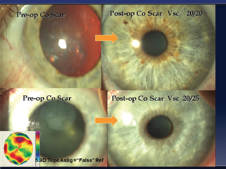 Corneal Haze After PRK Enhancement of Prior LASIK