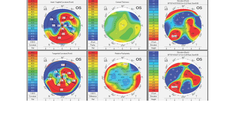 Multifocal Corneas