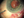 Figure 2. Once through the edge of the capsulorhexis,
the needle is rotated back superiorly under the nasal
iris.