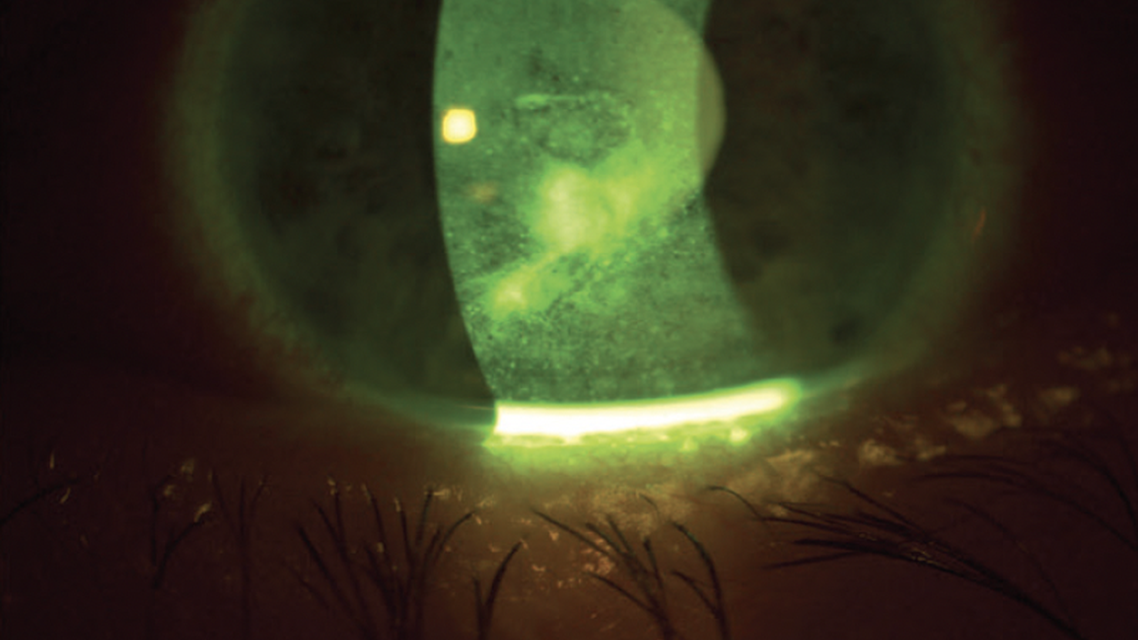 Neurotrophic Keratitis Post Retinal Detachment Surgery