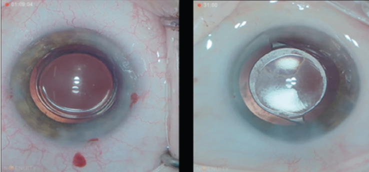 The New ZEISS CT LUCIA 621P IOL