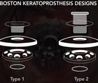 Type 2 Boston Keratoprosthesis for End Stage Ocular Cicatricial Pemphigoid