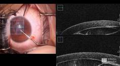 Intraoperative OCT for Corneal Cyst Removal thumbnail