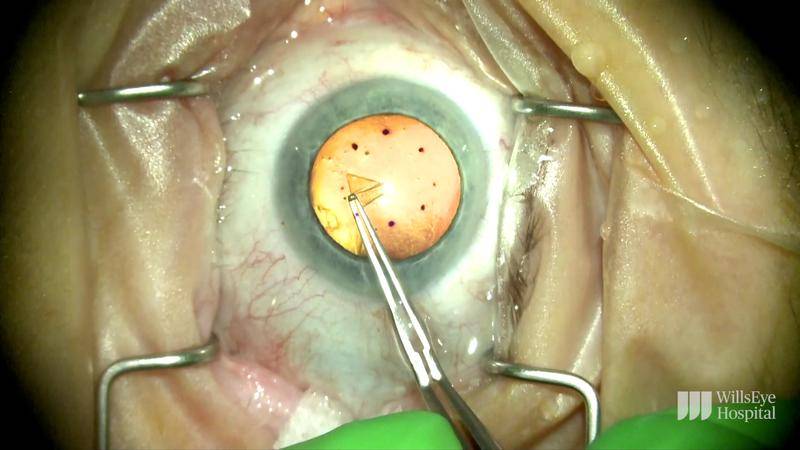 Performing Descemet Stripping Only to Treat Fuchs Endothelial Dystrophy thumbnail