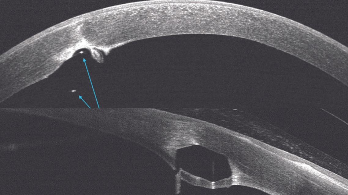 Intrastromal Corneal Ring Segment Erosion Into the Anterior Chamber