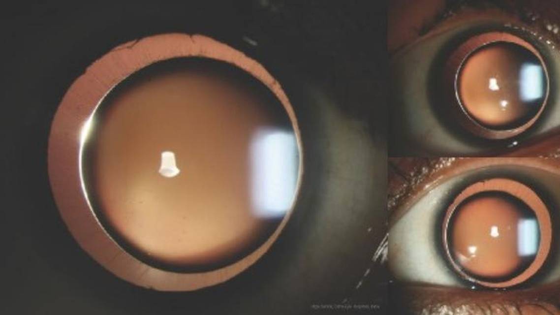 Bilateral Microspherophakia With High Myopia