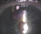 Transillumination Defects After the Implantation of a One Piece IOL in the Bag