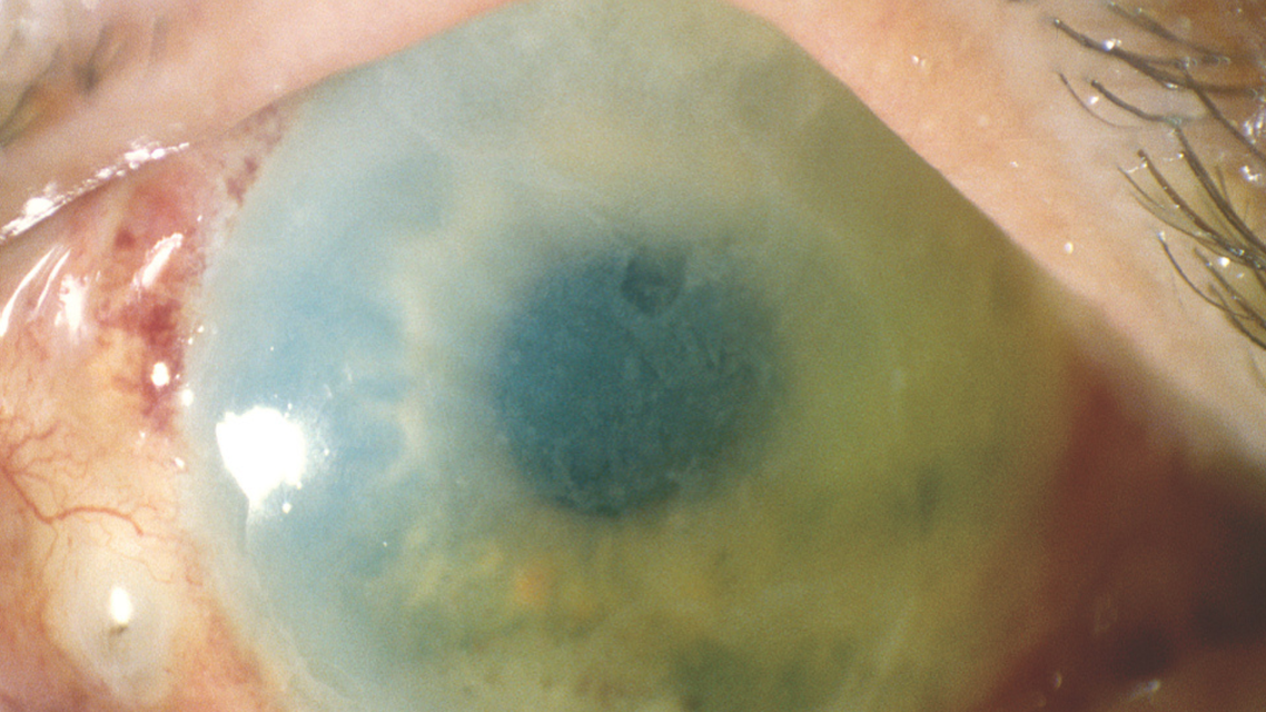 Origins Hero image showing diffuse limbus to limbus corneal edema