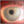 Figure 2. Postoperative image after concomitant
laser cataract surgery with toric lens
implantation and iStent inject.